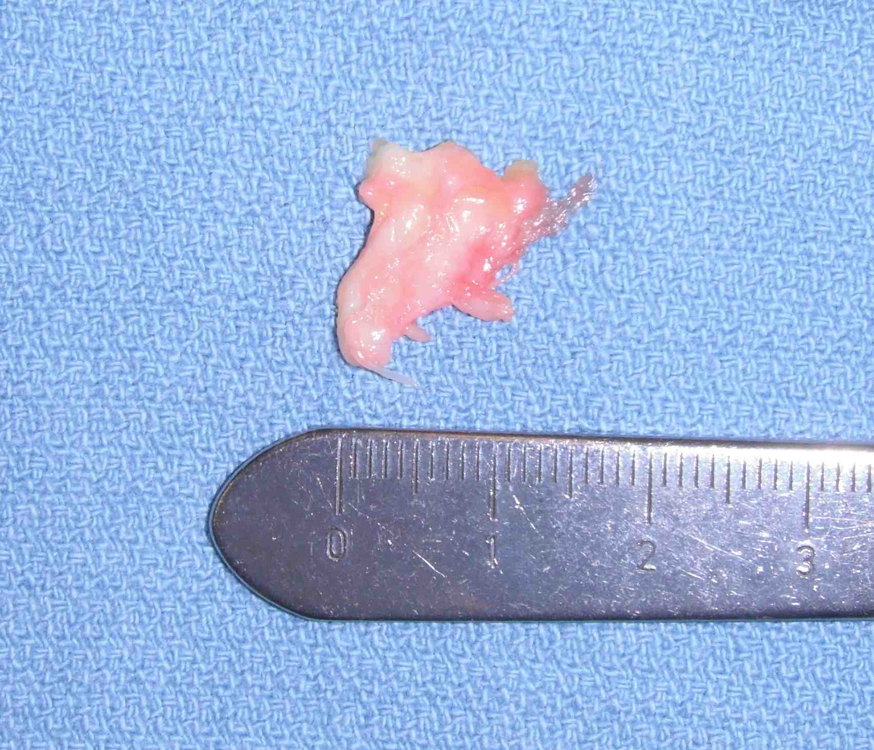 Mortons Neuroma